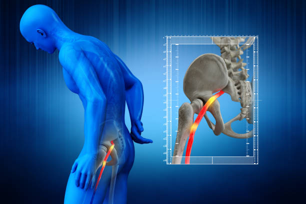 What is the most effective cure for sciatica?